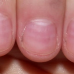 Lúnula: Saúde das Unhas